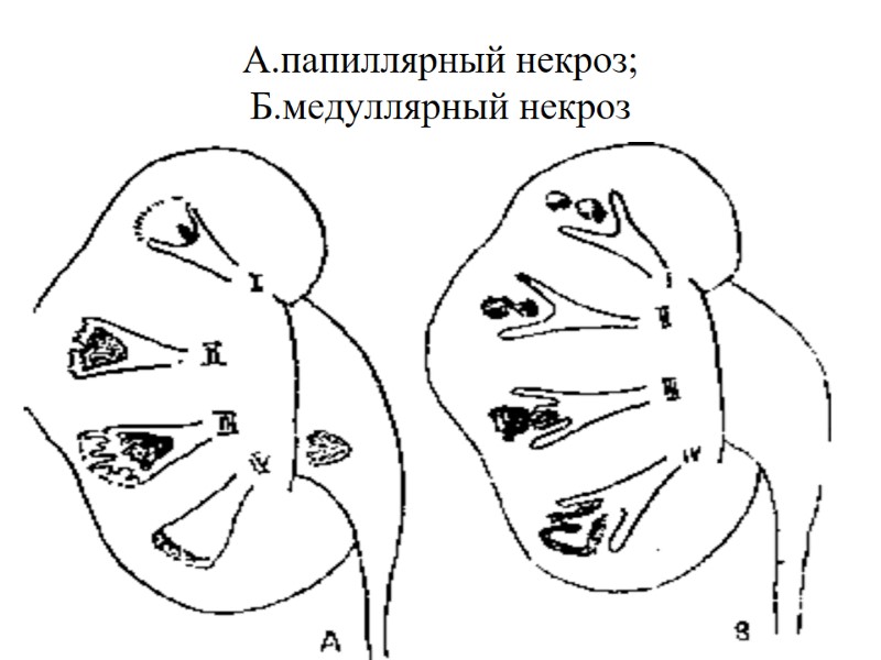 А.папиллярный некроз; Б.медуллярный некроз